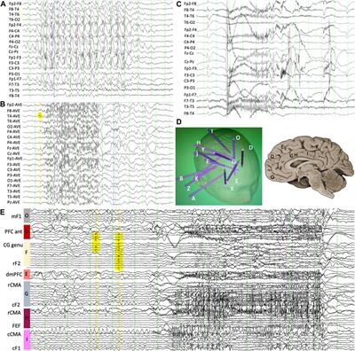 Case Report: Focal, generalized, or both: does generalized network involvement preclude successful epilepsy surgery?